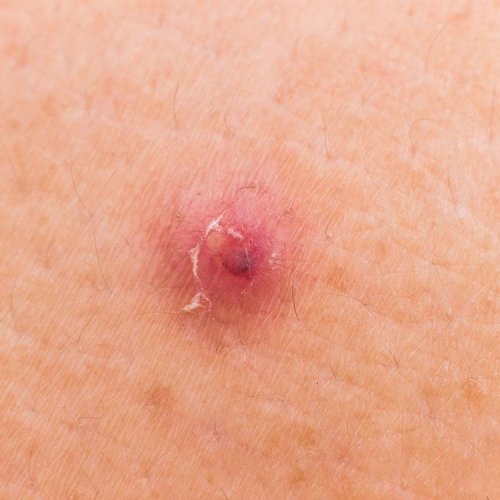 15 Bumps On Your Skin That Are Totally Normal—And You Shouldn't Pop