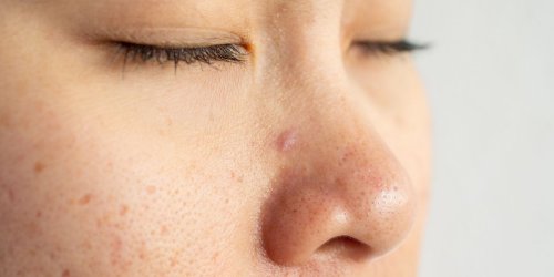 Sebaceous Filaments Vs. Blackheads—What They Are and How to Treat Them, According to Dermatologists