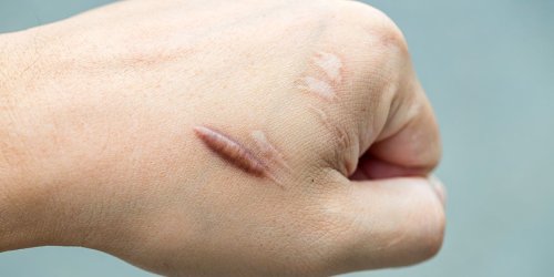 How to Get Rid of Scars, According to Dermatologists