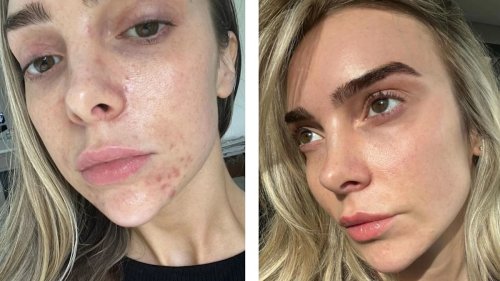 The £39.99 'Miracle Skin' treatment shoppers describe as 'unreal' and 'unbelievable'