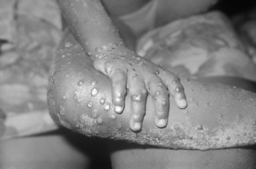 Scottish Government 'closely' monitoring monkeypox cases