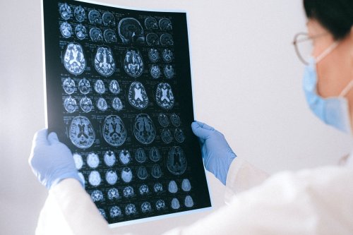 Vietnamese man with chronic headaches had chopsticks in brain
