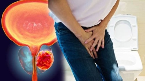 Warning signs of prostate cancer you should not ignore