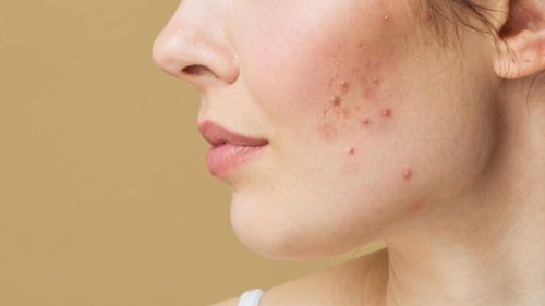 How to deal with hormonal acnes: Experts share tips