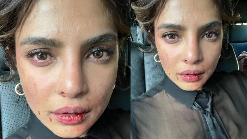 Priyanka Chopra shares pic of bruised face from sets of Citadel, fans ask 'What happened are you ok'. See pic