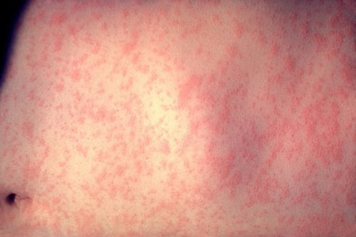 Second Measles Case Hits Cook County Suburbs, Prompting Cautious Urgency Among Health Officials