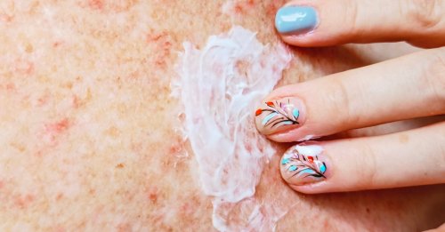 The Best Products For Treating Psoriasis, According To Dermatologists