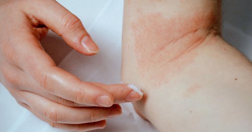 My Definitive List Of Products That Actually Make My Eczema Tolerable