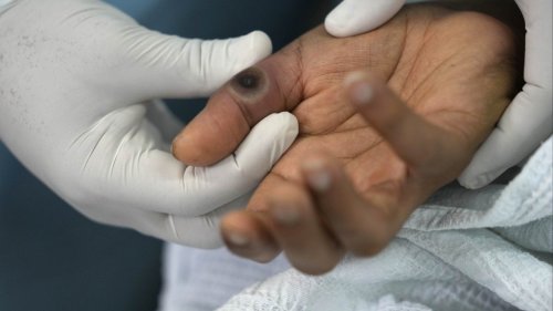 Are smallpox vaccines effective against the new monkeypox variant? Hong Kong research offers first insight