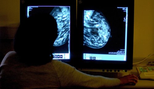 Call for changes to breast surgery as ‘women are at risk of recurrence’