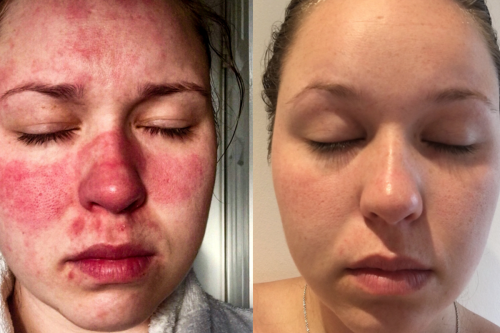 Woman with skin condition that made it ‘agony’ to shower transforms her complexion with £22 cream