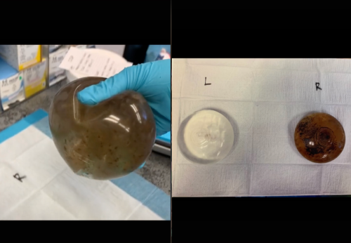 Woman shares photo of ‘mouldy’ breast implant that led to autoimmune disorder