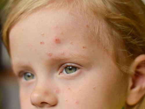 scarlet-fever-symptoms-to-look-out-for-and-how-to-treat-flipboard