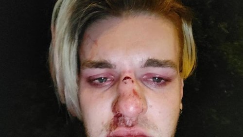 ‘Next thing I know I’m looking down at my shoes completely covered in blood’: Man (26) opens up about ‘vicious’ homophobic attack on Dublin Bus