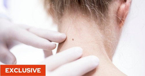 Skin cancer: New treatment could be available within decade after major discovery about how melanoma spreads