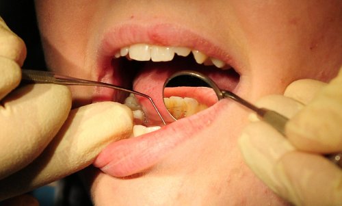 NHS dentists: Growing number of ‘dental deserts’ as shortages leave patients without treatment