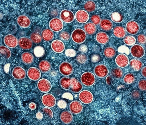 Mehr Fälle von Mpox – aber Experte bislang gelassen