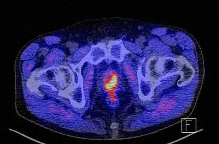 Häufigste Krebserkrankung bei Männern: Uniklinikum informiert über Prostatakrebs