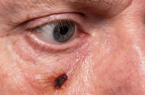 Basaliome als große Gefahr: So erkennst du weißen Hautkrebs am Auge