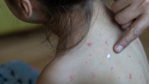 Florida Battles School Outbreaks of Measles and Meningitis as 11-Year-Old Dies in Volusia County