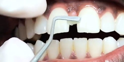 How dentists and fill in tooth gaps - Flipboard