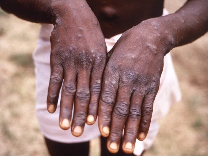 Monkeypox cases in the UK are under 'urgent investigation,' with 7 new infections