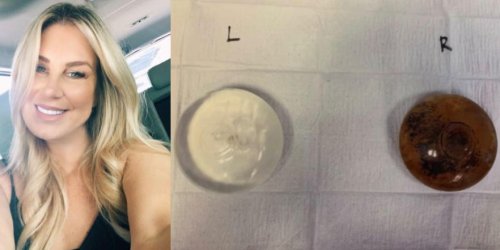 A Texas woman says she suffered with unexplainable physical and mental health issues for 10 years — then she got her breast implants removed