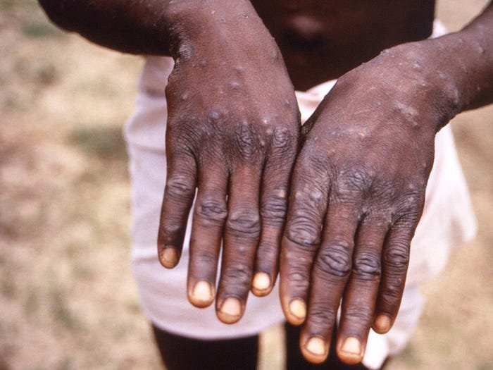 UK confirms case of monkeypox, which causes boils and full-body rashes