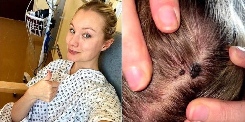 A 29-year-old woman found a mark on her head, and was diagnosed with a fungal infection. It turned out to be invasive skin cancer.