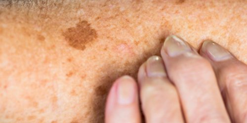 Dermatologists give a detailed 3-step plan to diminish dark spots for good
