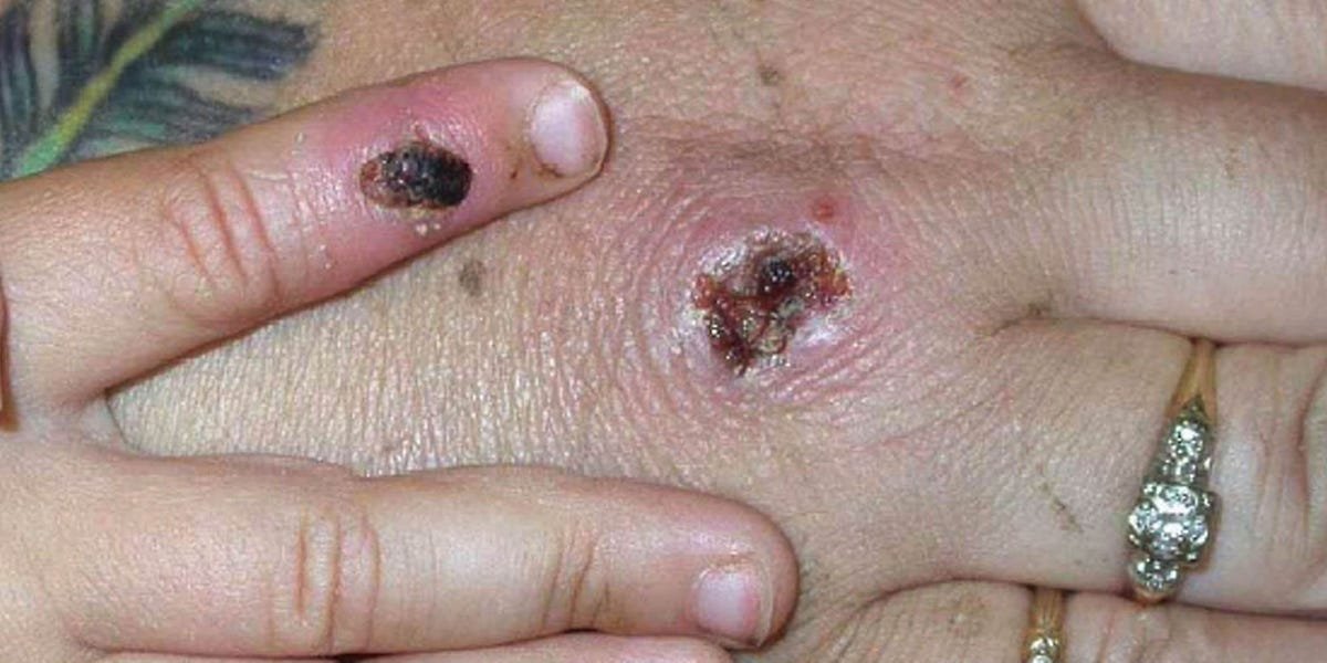What to know about monkeypox symptoms as the virus spreads in an unusual way across the US and Europe