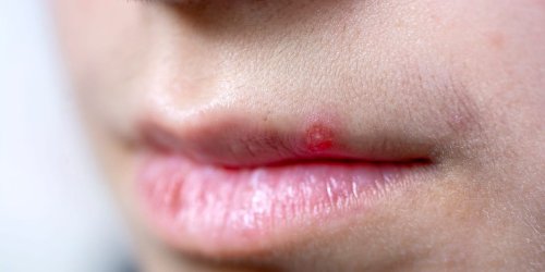 7 tips to make a lip pimple disappear quickly - Flipboard