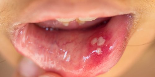 6 causes of white spots on gums and how to get rid of them