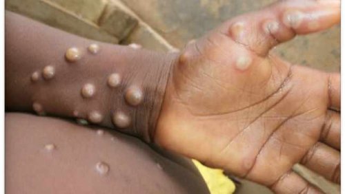 KZN on high alert for possible monkeypox outbreak - Health MEC
