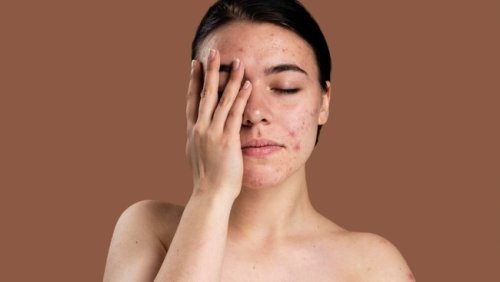 Tips on how to take care of acne-prone skin