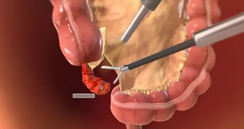 The Surgeon Who Had to Remove His Own Appendix