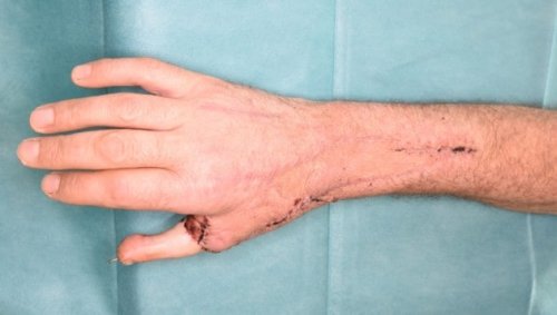 Sensationelle Operation: Aus Zeh wird Daumen