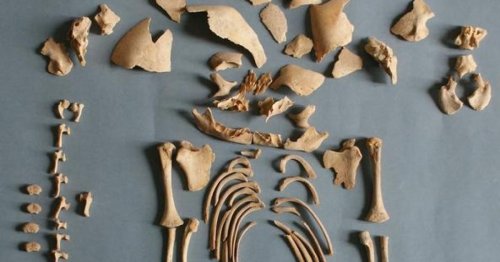 Down-Syndrom gab es bereits in der Bronze- und Eisenzeit