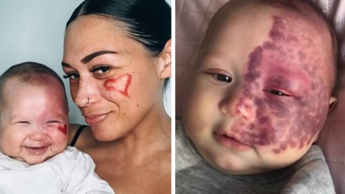 Mum called a 'monster' for choosing to laser birthmark on baby's face