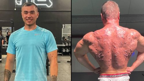 Bodybuilder shows off serious damage steroids have done to his body in a bid to warn others