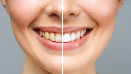 Dentist reveals daily mistake you’re making that’s causing teeth to turn yellow