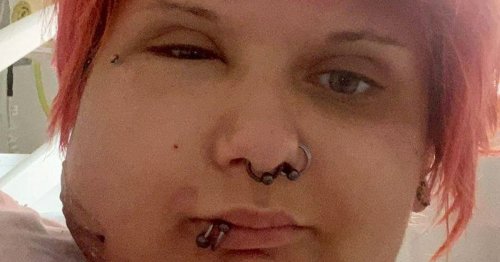 Woman's face covered in boils after brushing against plant
