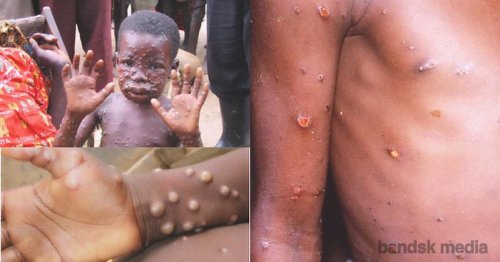 Monkeypox cases triple in Europe, WHO says, Africa concerned