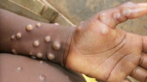 Can New Monkeypox Variant Cause Global Health Crisis? Here’s What You Need To Know About Clade 1b Mutation With ‘Pandemic Potential’ Found in Democratic Republic of Congo
