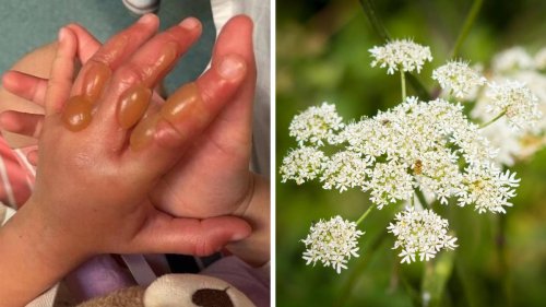 Giant hogweed warning as girl, 4, suffers horrific burns while playing in park