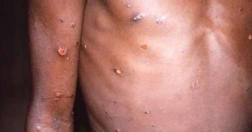 Several cases of Monkeypox found in Yorkshire