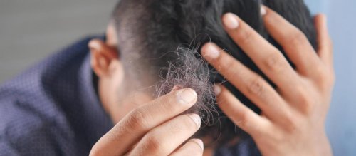Pourquoi parle-t-on d’une épidémie de chute de cheveux en Belgique ?