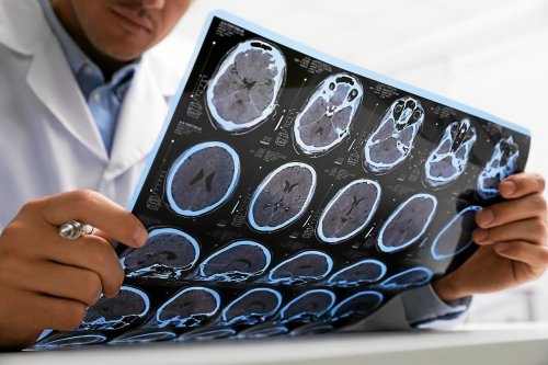 Sclérose en plaques : l’effet protecteur de fortes doses de vitamine D