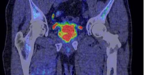 Cancer de la prostate : «La maladie à l’état métastatique ne se guérit pas, mais on vit avec»