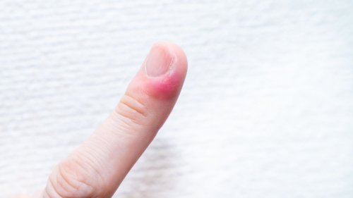 Nagelbettentzündung am Finger oder Zeh: Was hilft?
